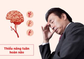 Thiểu năng tuần hoàn não: Nguyên nhân, triệu chứng và cách khắc phục